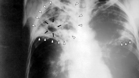 tuberculose-radiographie