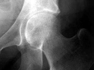 hanche-radiographie