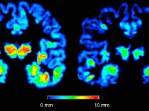 cerveau-alzheimer-cortex