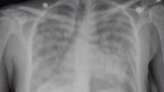 Radiographie des poumons d'un patient atteint de la grippe A (H1N1)