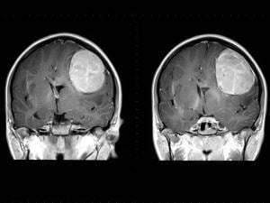 Une tumeur au cerveau