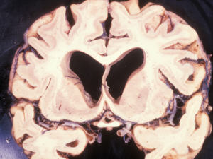 Cerveau humain