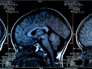 Un scan du cerveau