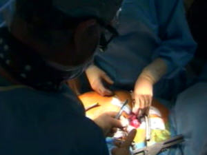 Une chirurgie cardiaque