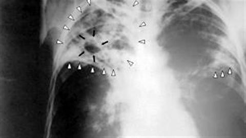 tuberculose-radiographie