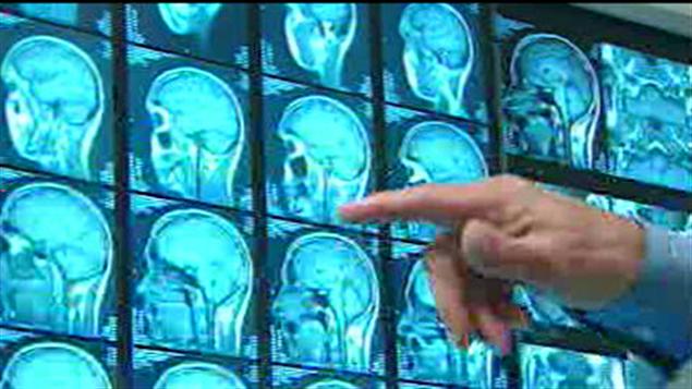 cerveau-commotion-cerebrale