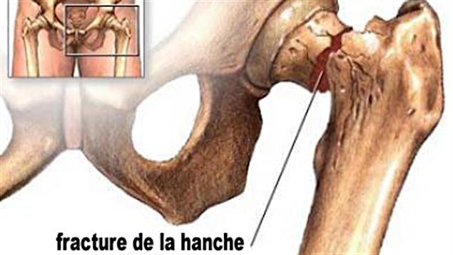 Environ 30 000 fractures de la hanche sont dénombrées chaque année au Canada