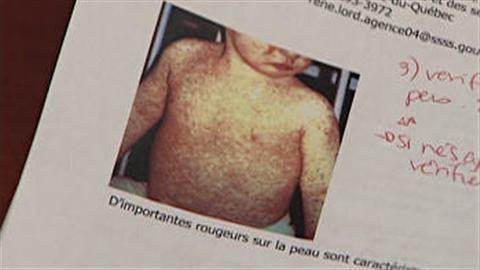 70 cas de rougeole ont été dénombrés sur le territoire du CSSS de Drummondville.