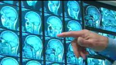 commotions cerebrales