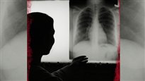 Le retour de la tuberculose