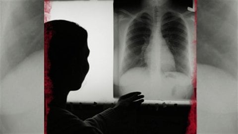Tuberculose