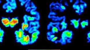 Contre le cancer, mais aussi l'alzheimer