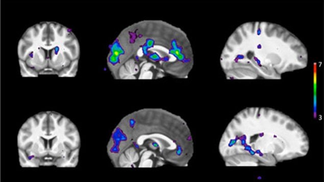 Le cerveau d'un fumeur 
