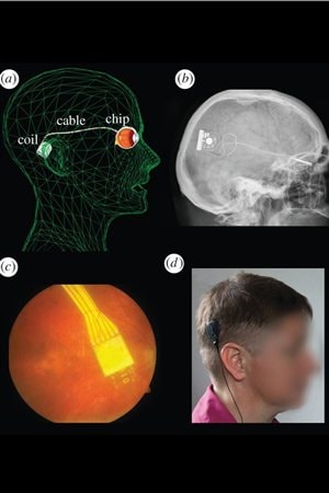 Schéma, radiographie et photos montrant l'emplacement de l'implant, du câble et de l'appareillage