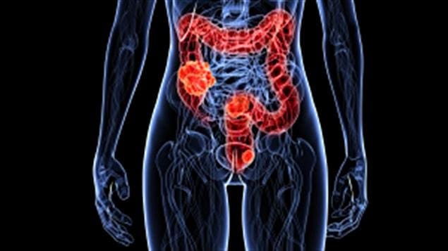 Cancer du colon