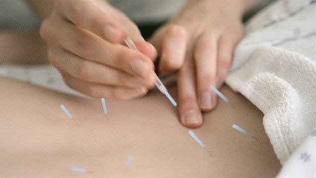 Dr. Mubai Qiu claims to have given acupuncture treatment to as many as 461 patients in a single day.