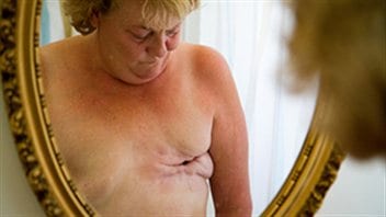 cancer du sein canalaire