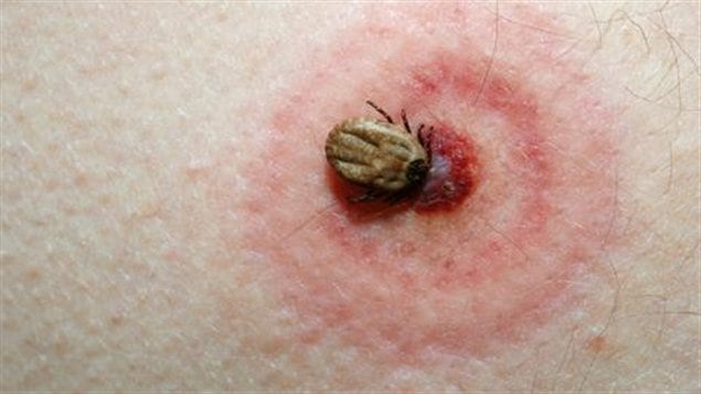 Symptôme cutané de la maladie de Lyme.