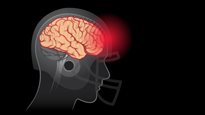 Commotions cérébrales : jeunes cerveaux en péril