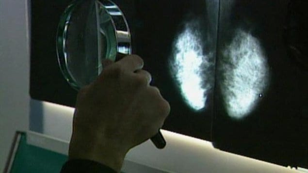La mammographie ne serait pas plus efficace que l'examen traditionnel des seins, selon une étude ontarienne publiée hier dans le British Medical Journal. Près de 90 000 Canadiennes ont été suivies pendant 25 ans pour effectuer cette étude. L'épidémiologiste Anthony Miller et ses collègues de l'Université de Toronto estiment même que la pratique de la mammographie annuelle comporterait des désavantages.
