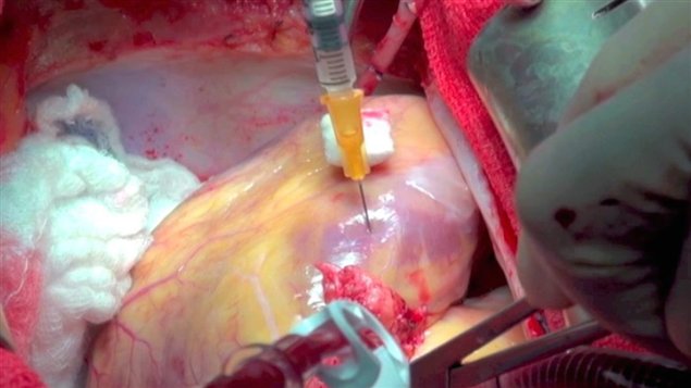 Médicos inyectan células madres extraídas de la médula dorsal en el corazón de un paciente, para regenerar los vasos sanguíneos y las células musculares del corazón.