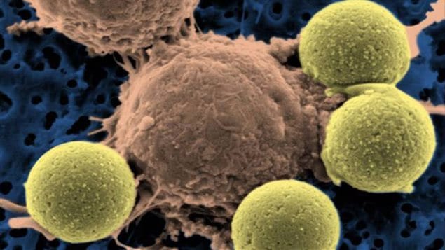 Les cellules T d’un patient atteint de leucémie