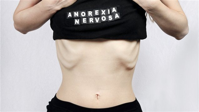 Obesity anorexia nervosa and bulimia nervosa essay