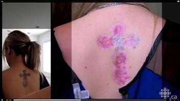 Tattoo removal gone wrong; permanent scars