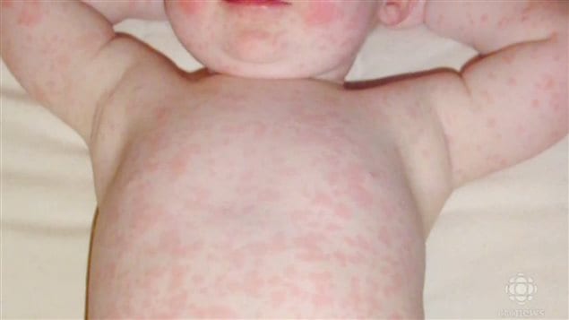 measles Picture Image on MedicineNet.com