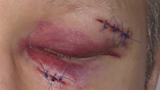 Un infirmier à Abbotsford en Colombie-Britannique a subi des blessures à la tête et au visage après avoir été attaqué par un patient. 
