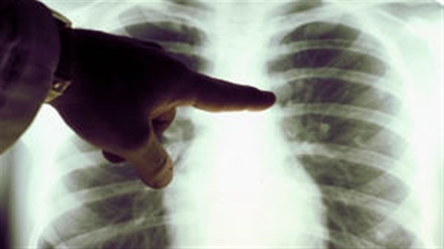 El cáncer amenaza a los canadienses si no se cambian las polítcias actuales.