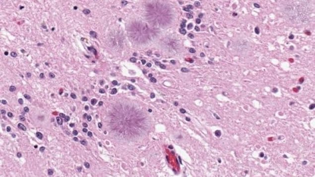 Slice of human brain showing variant CJD. the white spots are actual spaces in the tissue, ie. holes, hence the resemblance to being sponge-like as in spongiform encephalopathy. 