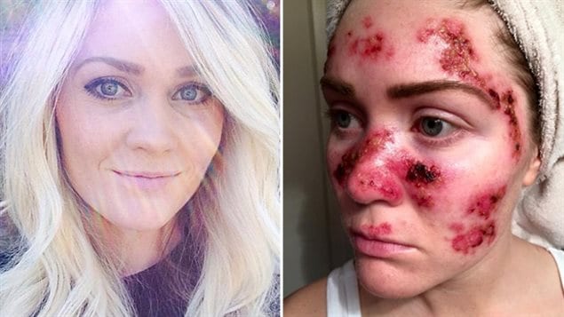 At just 27 years old, Alabama nurse and new mom Tawny Willoughby has been diagnosed with skin cancer six times. She blames her former tanning bed habit, and wants to prevent others from making the same mistake. 