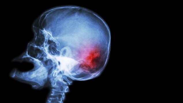 Rayons X d’un cerveau lors d’un accident vasculaire cérébral (AVC)