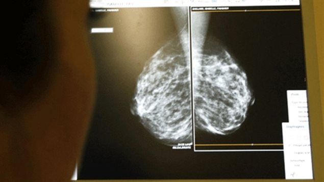 Le couplage des données permettra par exemple qu'une radiographie de seins comme celle-ci soit plus accessible dans l'ensemble du pays pour assurer un meilleur suivi du patient