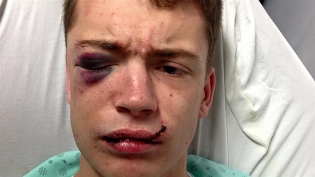 Mathieu Grégoire au lendemain d'une agression homophobe subie au Festival western de Saint-Tite, en septembre 2015 Mathieu Grégoire au lendemain d'une agression homophobe subie au Festival western de Saint-Tite, en septembre 2015