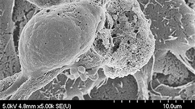 Aspergillus fumigatus colony invading lung cells