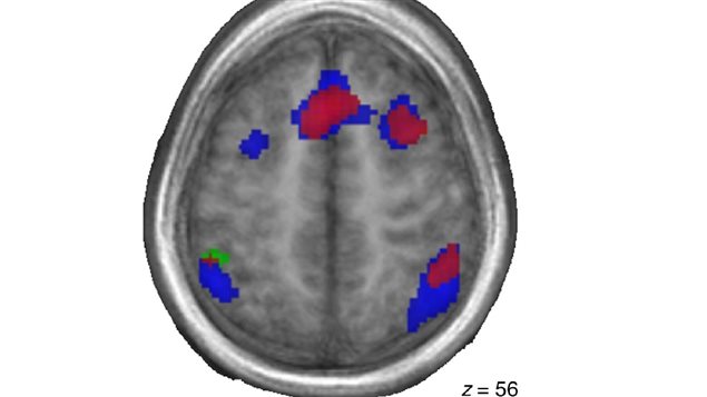 t-map showing overlay of activation for bilinguals (red), international adoptees (blue), and monolinguals (green) during the 2-back condition. Slices are shown in the axial plane and demonstrate the similarity between the bilingual and internationally adopted groups. The left hemisphere is on the left side. Monolinguals n=10; bilinguals n=12; international adoptees n=21.