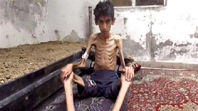 Esta foto sin fecha difundida por el Consejo Revolucionario local del Madaya muestra un niño víctima del hambre y la guerra en Siria. La agencia Associated Press afirma haber verificado la autenticidad de esta imagen.