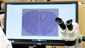 A Canadian study suggests strong marijuana can cause changes in the developing brain similar to those in the brains of schizophrenics