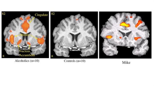 In the documentary, they find scientific evidence of a genetic connection to addiction.