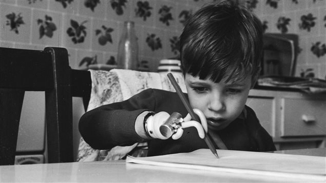 En 1964, Brett Nielsen un enfant né sans bras en raison de la thalidomide tente d'écrire avec une prothèse. En 1964, Brett Nielsen un enfant né sans bras en raison de la thalidomide tente d'écrire avec une prothèse.