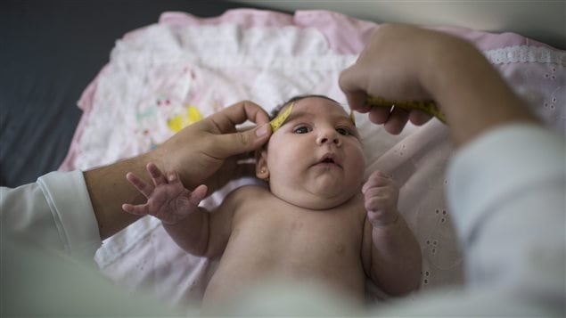 In this Dec. 22, 2015 photo, a neurologist measures the head of a Brazilian baby who’s head was more than 3 cm below the healthy range at birth. This condition, called microcephaly has been linked to the Zika virus.