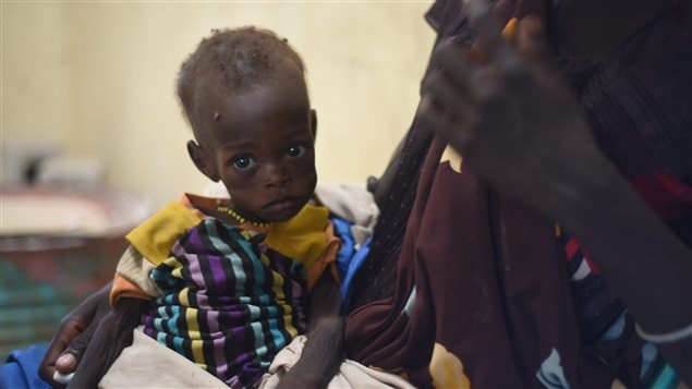Un enfant souffrant de malnutrition au Soudan du Sud.