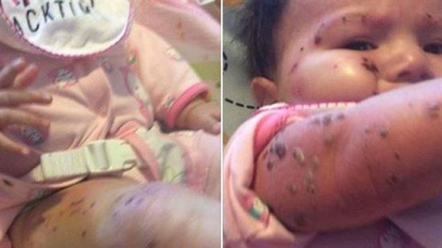  Derek Stephen of Kashechewan posted photos on social media of the angry-looking bumps and rashes on his niece’s legs and face. The baby is now receiving medical treatment in Timmins, Ont. (Derek Stephen/Facebook)