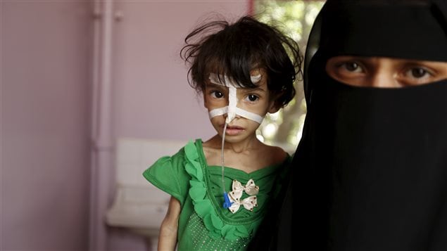  A woman holds her malnourished daughter at a hospital in Yemen’s capital Sanaa July 28, 2015. 