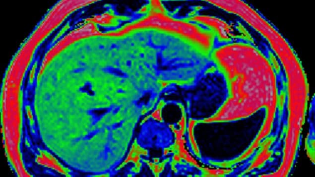 A magnetic resonance image across the abdomen of a person with Type 2 diabetes shows the red inside the circle representing 32 per cent fat in the liver. It should be less than five per cent.