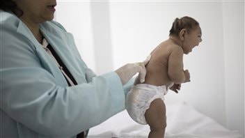 On Feb. 12, 2016, baby Lara who was born with microcephaly was examined at a hospital in Brazil. An outbreak of Zika is believed responsible for thousands of such birth defects in that country.