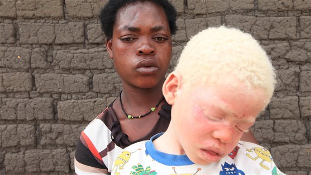 Edna Cedrick holds her surviving son after his twin brother who also had albinism was snatched from her on May 24 in Malawi. She says she is haunted by images of the decapitated head of her kidnapped son.