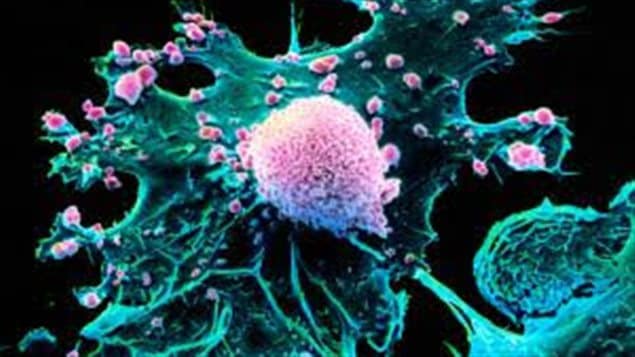 Obesity is linked with breast cancer and a new study suggests fat cells play an important role.